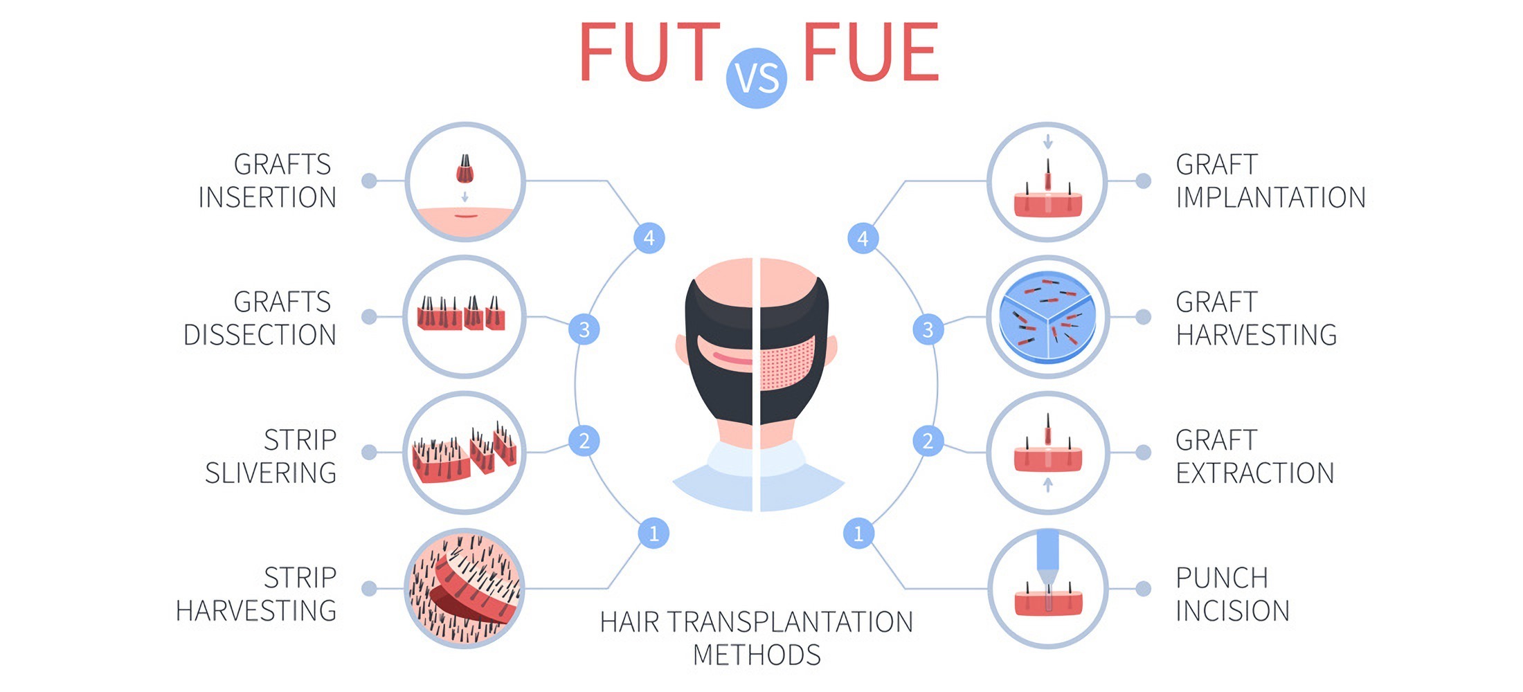 Методи трансплантації волосся