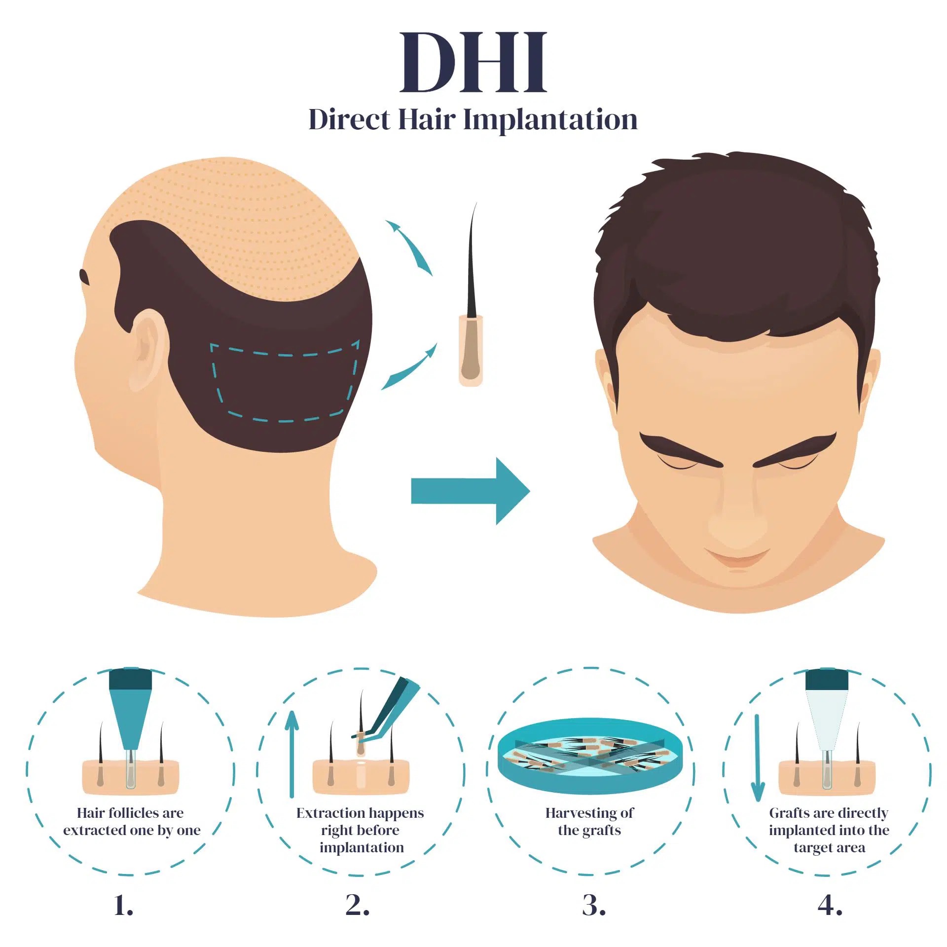 Трансплантація волосся DHI в Туреччині