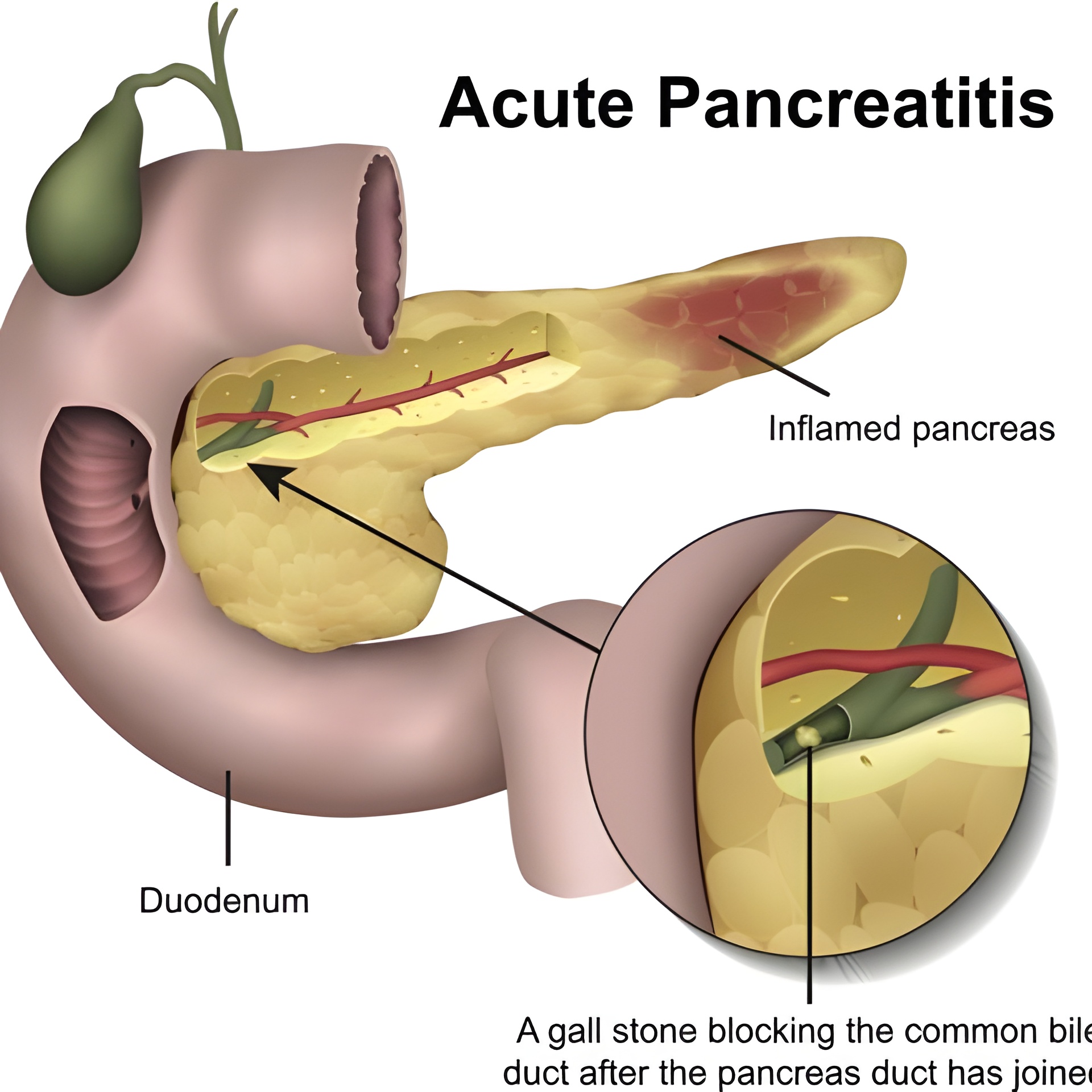 What are the symptoms of acute pancreatitis?