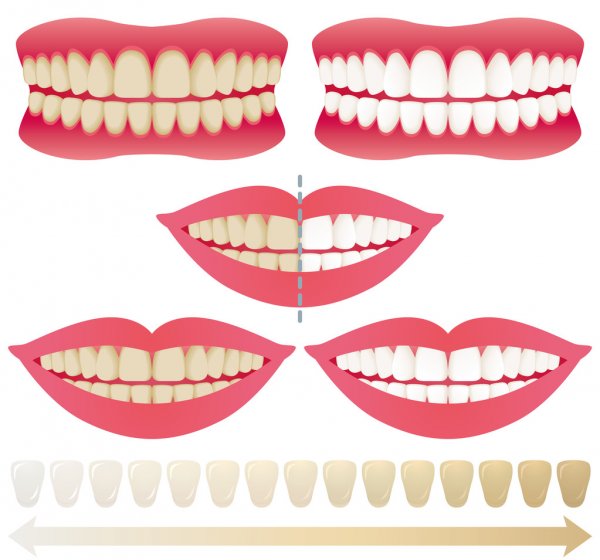 шкала кольорів для відбілювання зубів
