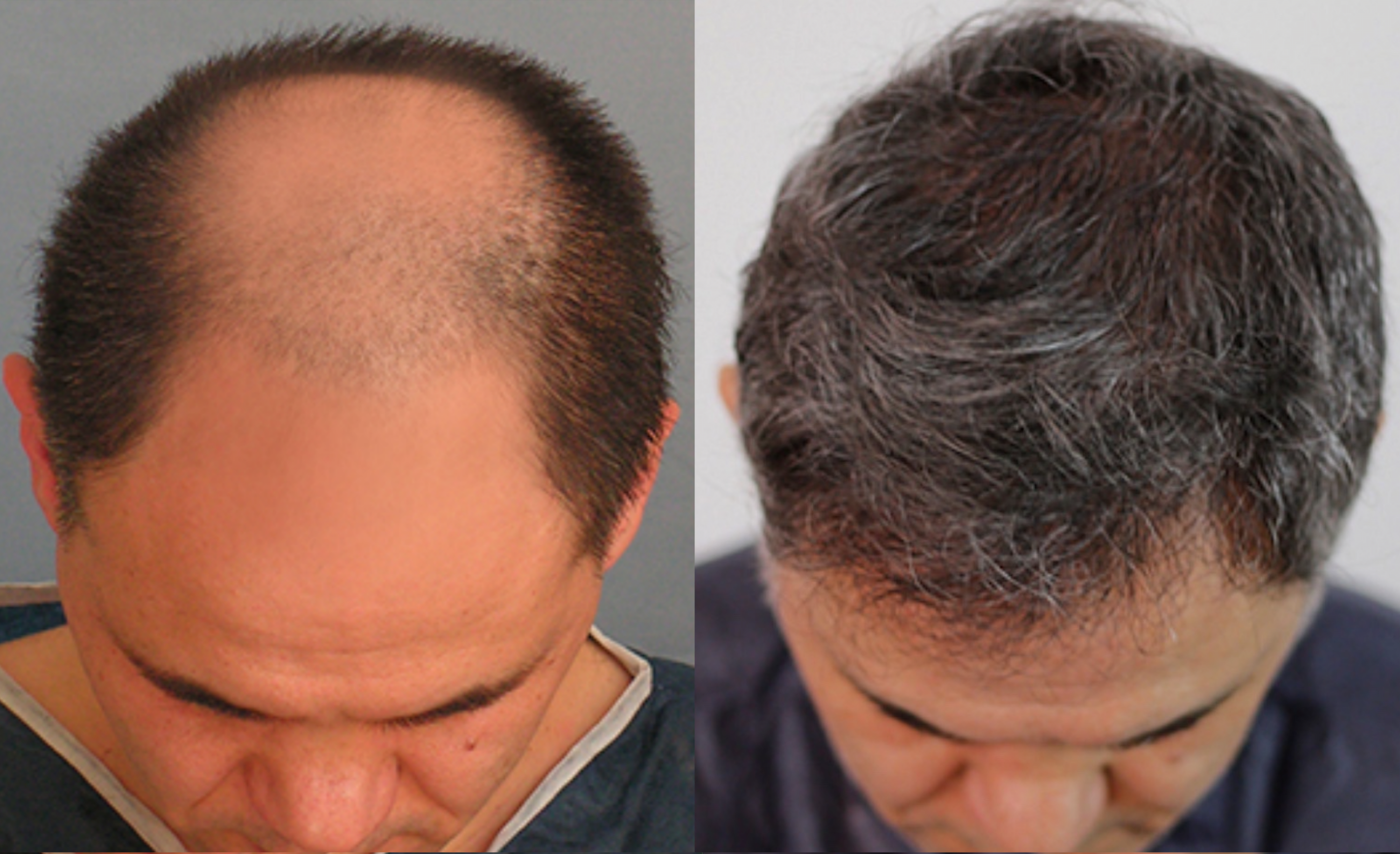 Трансплантація волосся чоловікові на лобі