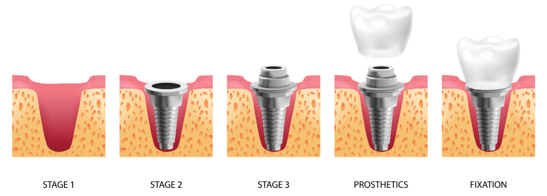Етапи встановлення зубного імпланта у Львові
