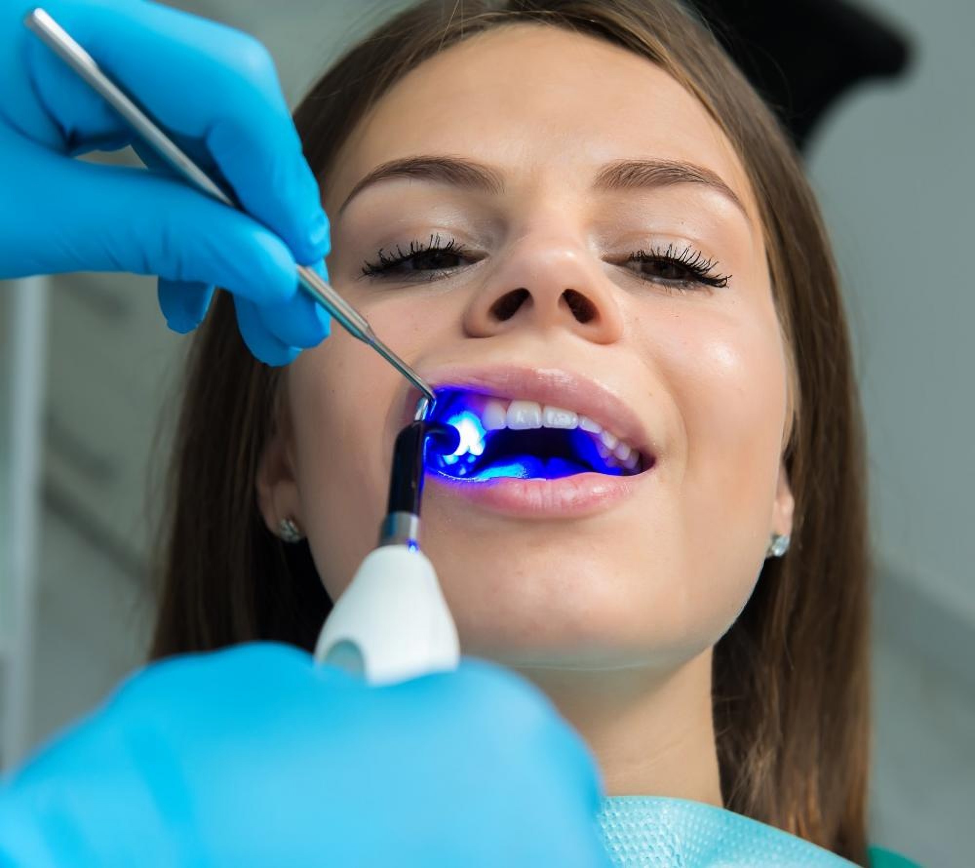 Пломбування зубів в стоматологічній клініці Granddent в Одесі Україна