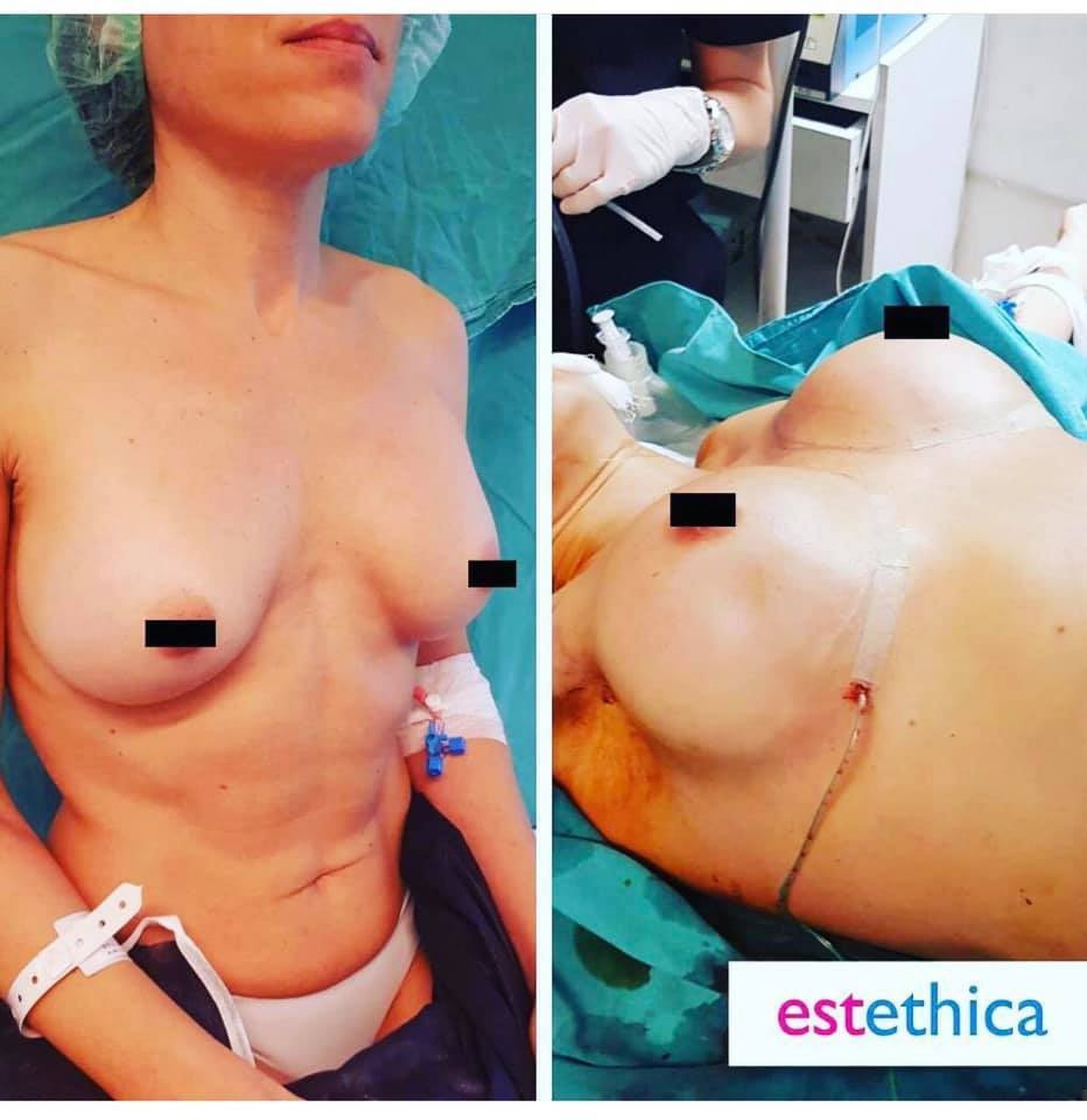 Збільшення грудей у Стамбулі в клініці Estethica