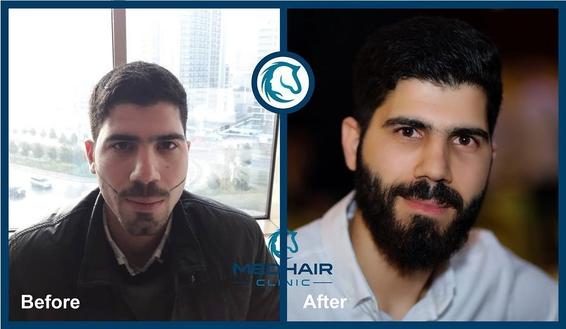Пересадка волосся в бороду до і після
