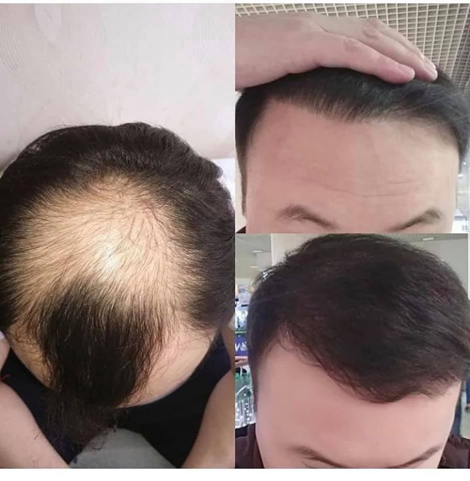 Пересадка волосся до і після в Стамбулі в клініці Estethica