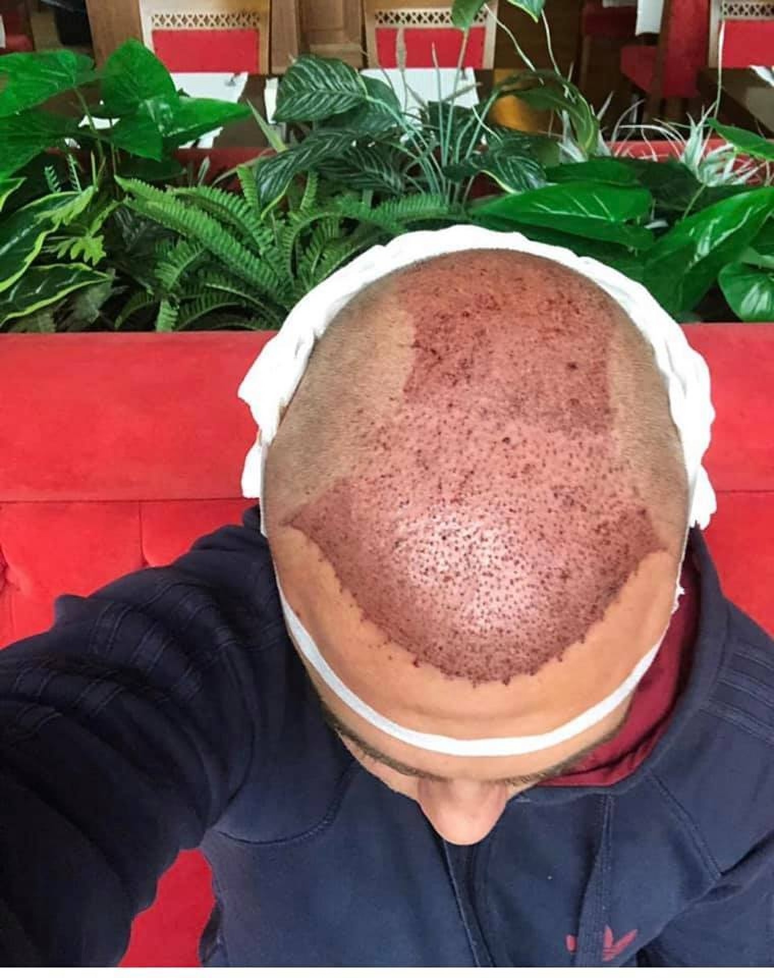 Пересадка волосся FUE у Стамбулі в клініці Estethica