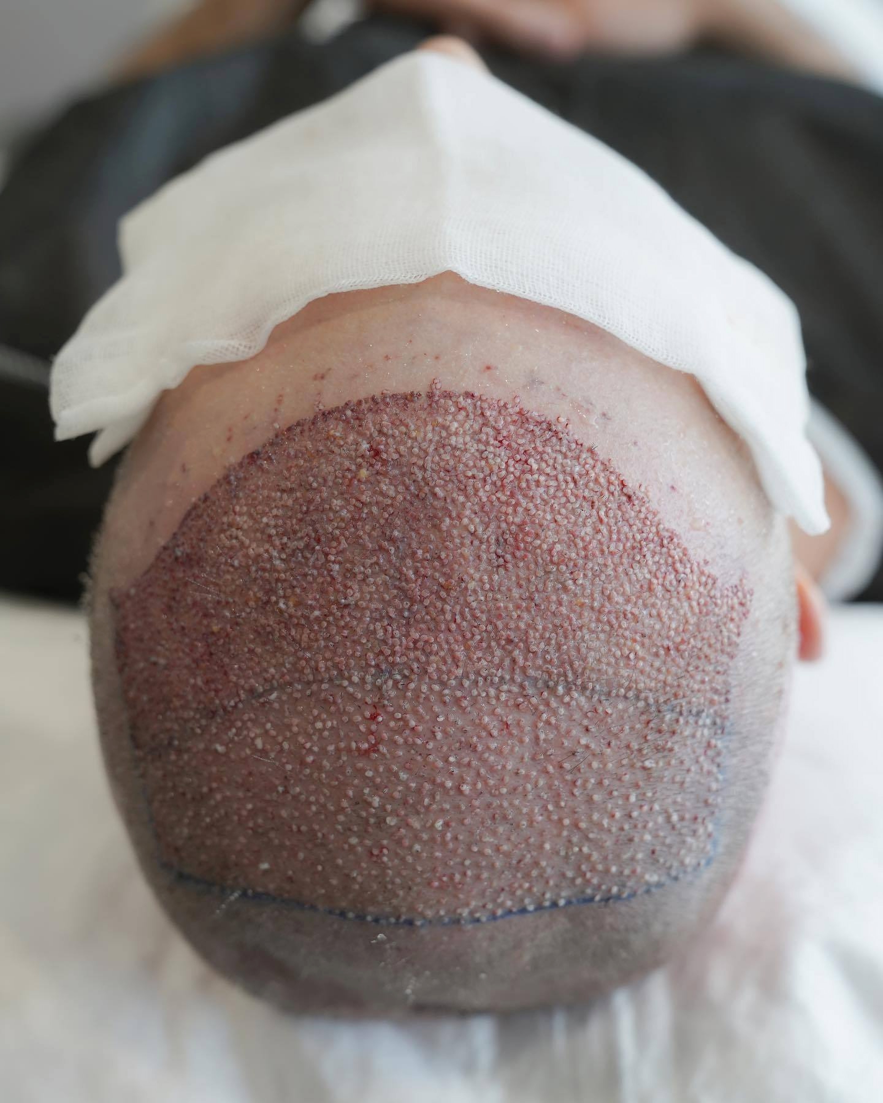 Шкіра голови після пересадки волосся в Туреччині