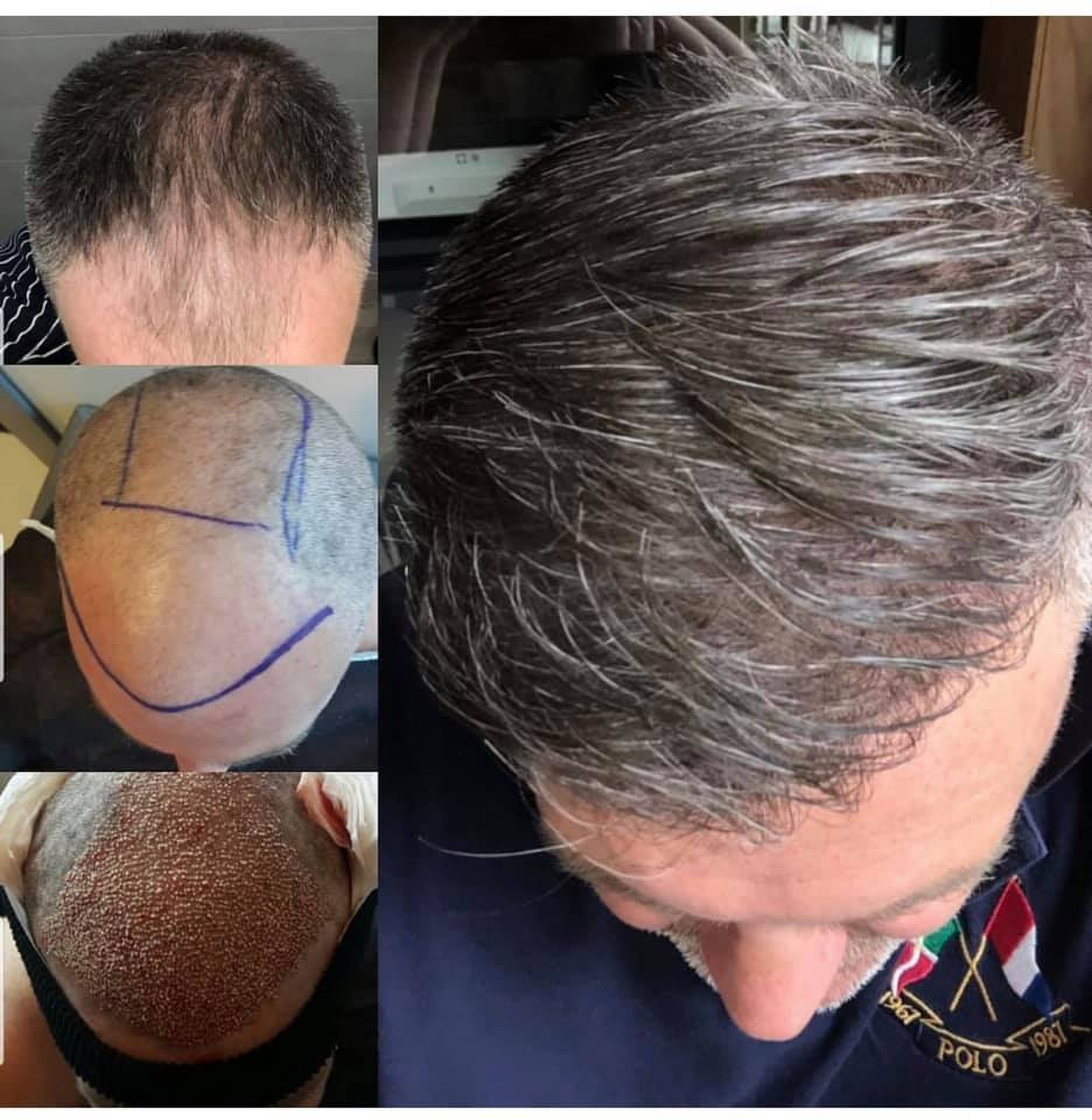 Результати пересадки волосся в Стамбулі в клініці Estethica