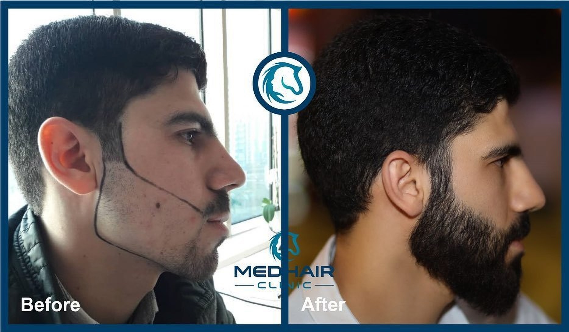 Пересадка волосся для бороди в Туреччині