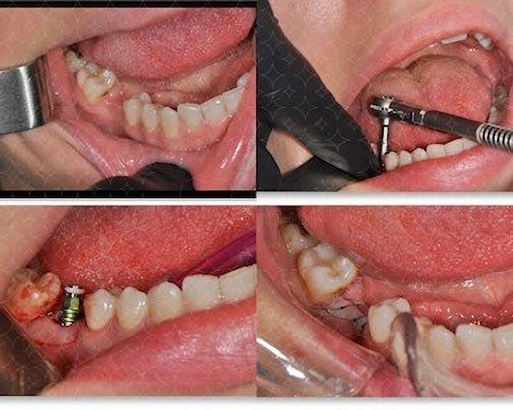 Встановлення зубних імплантів у вашій стоматологічній клініці в Одесі Україна