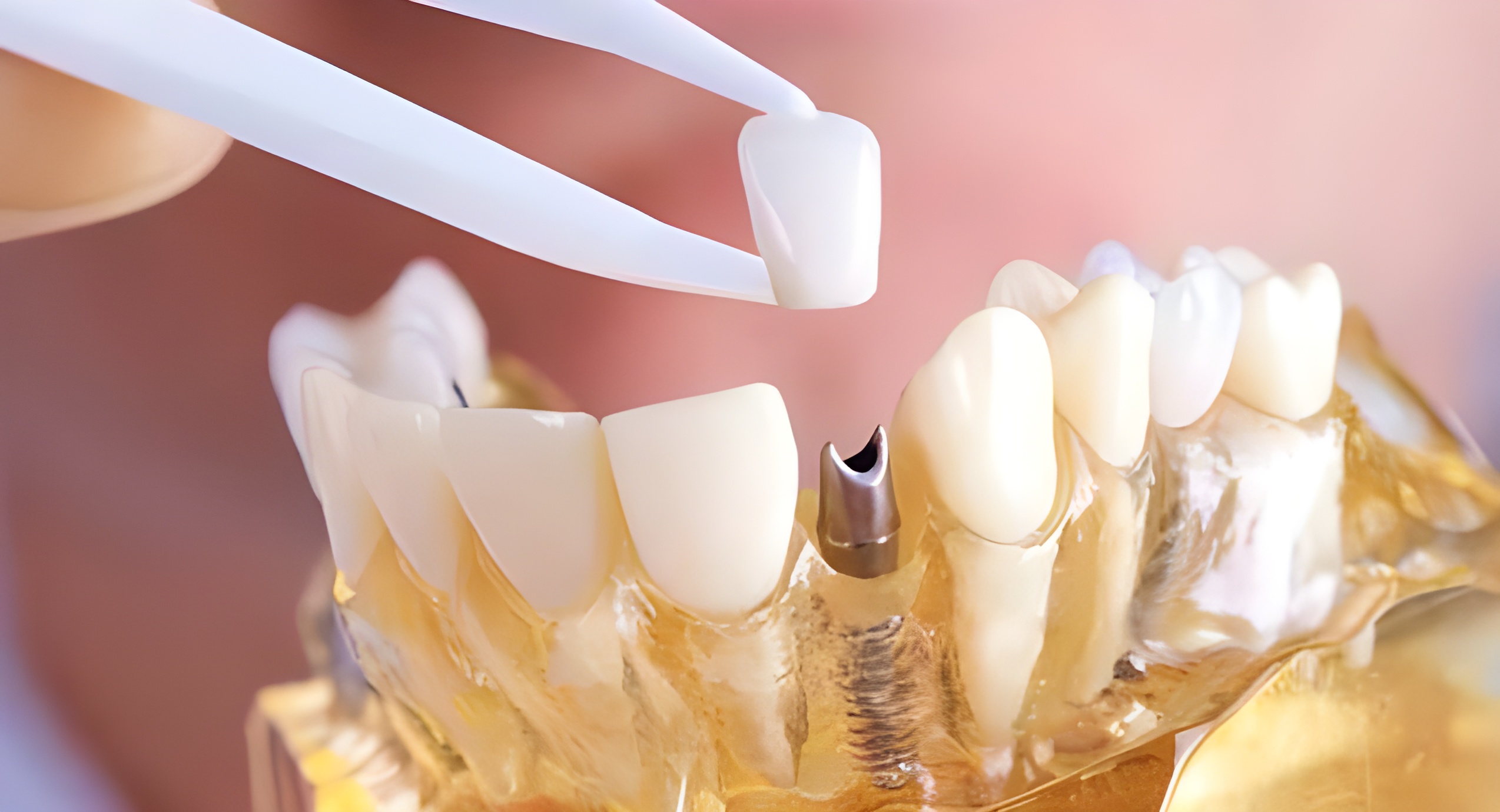Зубні коронки: основні види коронок