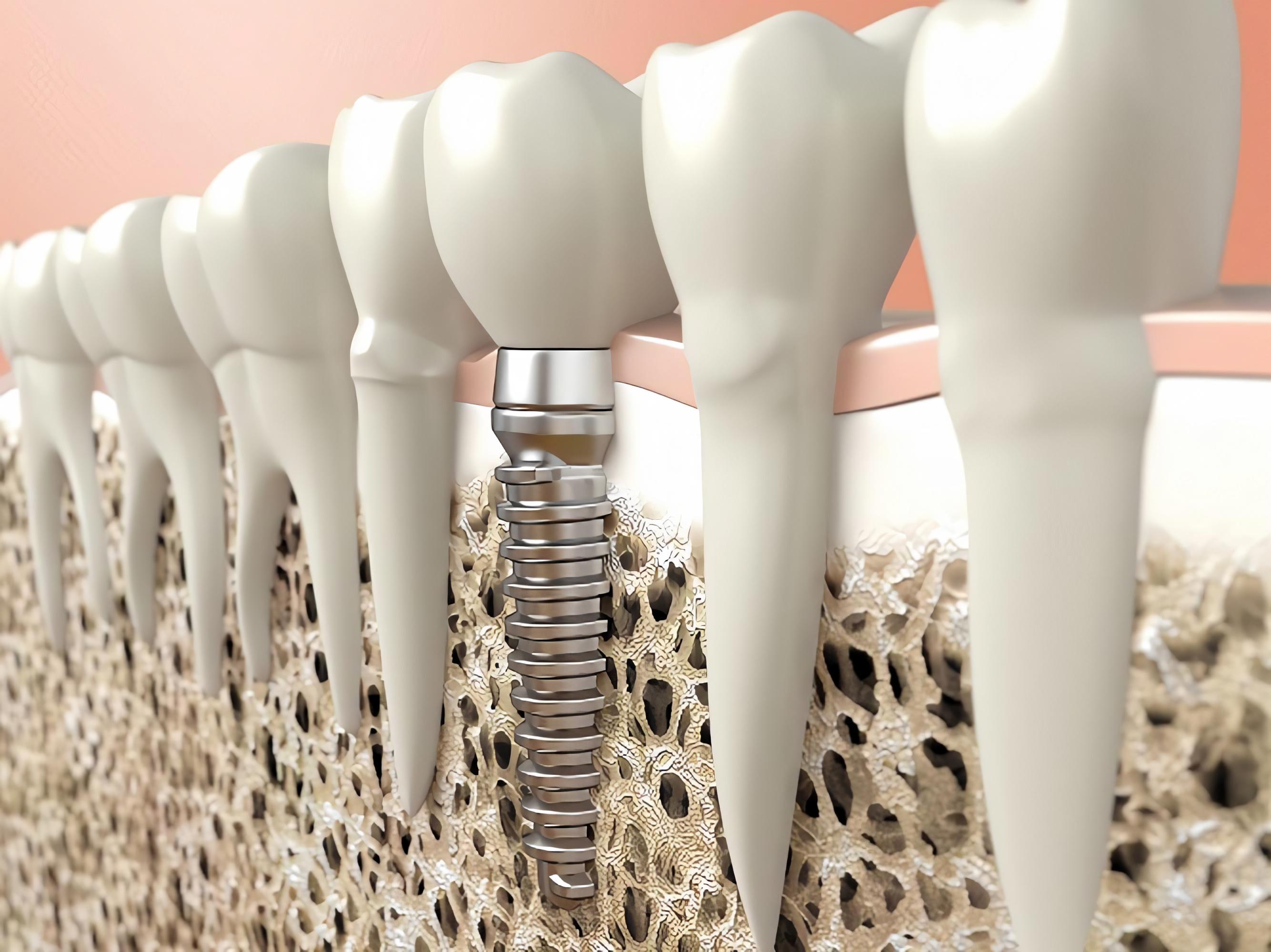 Чи можна імплантувати зуби при остеопорозі