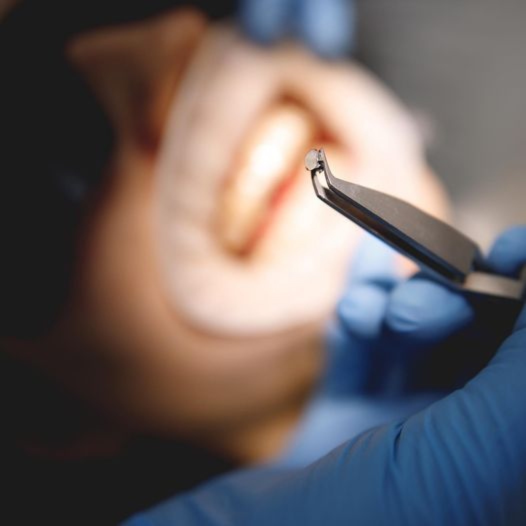 Імплантація в стоматології DGclinic Харків Україна